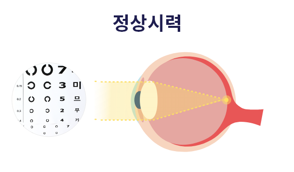 정상시력