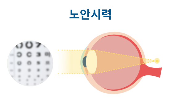 노안시력