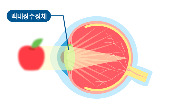 백내장