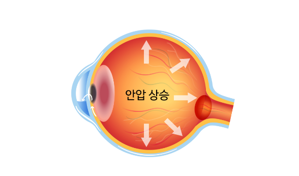 녹내장안